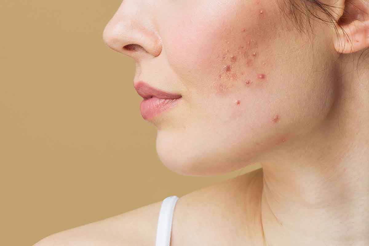 woman-acne-cheek-1200x800-1